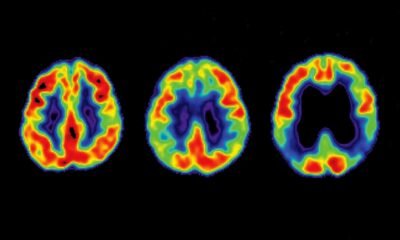 What Drives Alzheimer’s in Ladies?