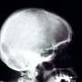World be taught about recommends changing cranium half after medicine for a brain bleed