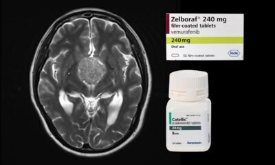 BRAF-MEK Inhibition Achieves ‘End to Standard’ Response in Uncommon Mind Tumor